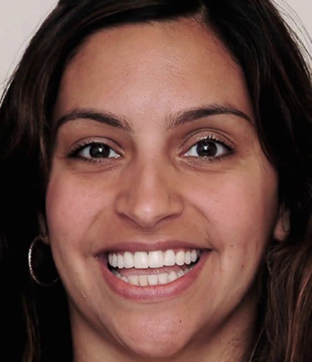 Before dental veneers